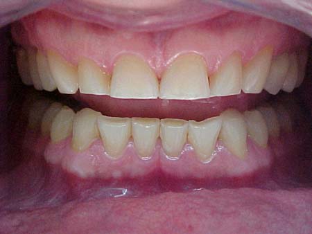 bruxismo - clinica dental las rozas