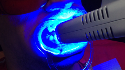 Blanqueamiento-dental-luz-led