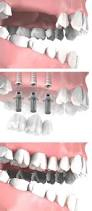 carga-inmediata-implantes-dentales-las-rozas-majadahonda