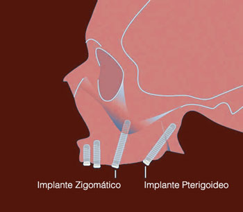 implantes-pterigoideos-las-rozas-majadamonda