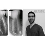 Dr Vincenzo Trentadue-Clinica dr. Crespo-participa en el estudio de investigación Máster Endodoncia y Cirugía Periapical UAX en 2018