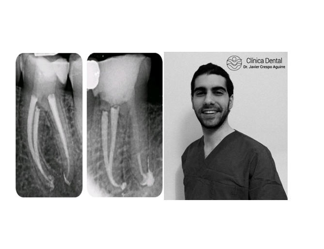 Dr Vincenzo Trentadue-Clinica dr. Crespo-participa en el estudio de investigación Máster Endodoncia y Cirugía Periapical UAX en 2018